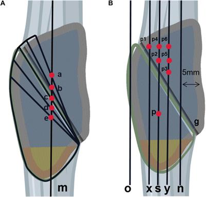Computational evaluation of wire position using separate vertical wire technique and candy box technique for the fixation of inferior pole patellar fractures: a finite element analysis